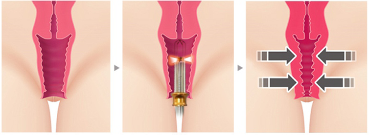 Genital Lazer Uygulamaları