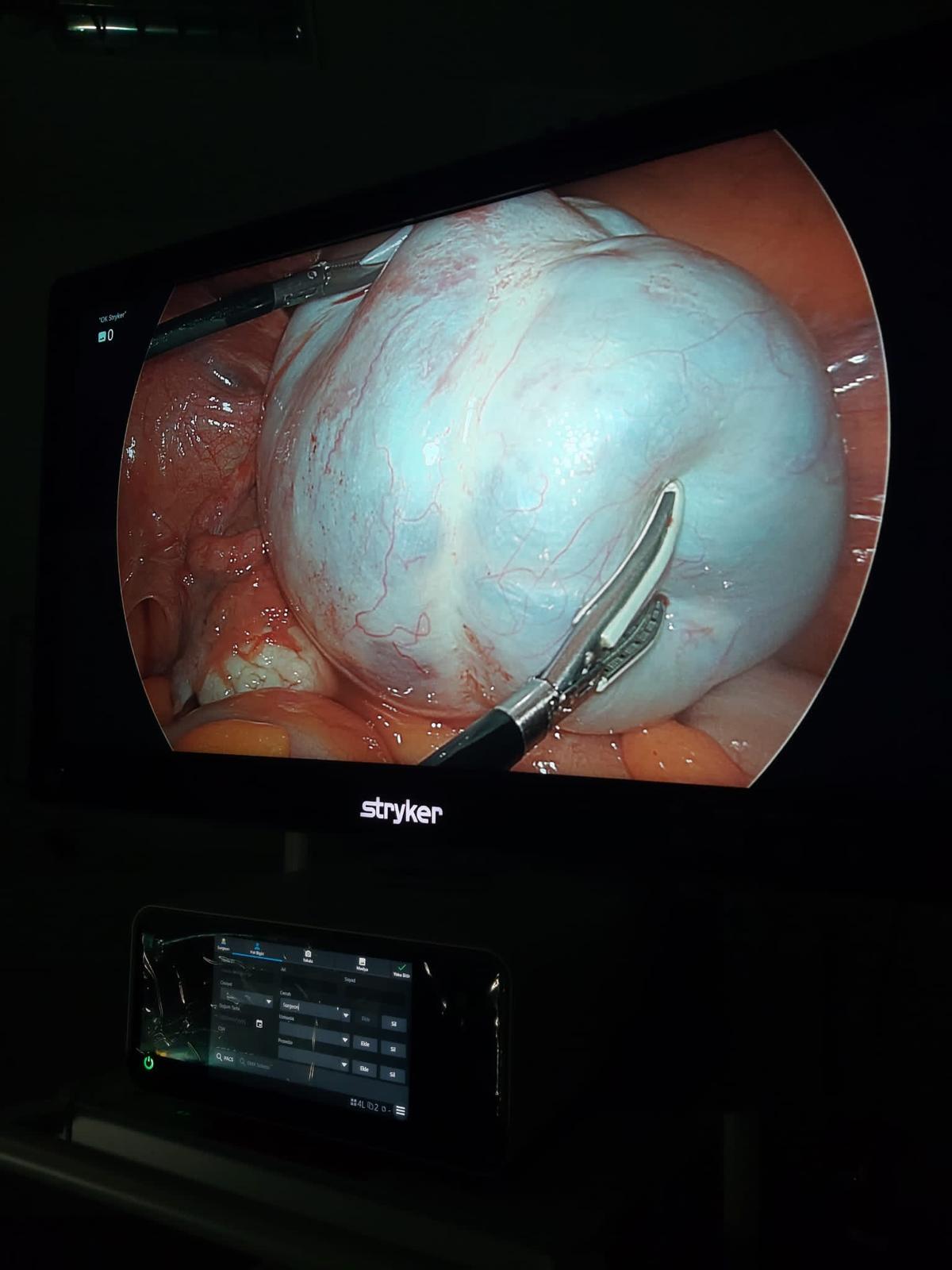 Yumurtalık Kisti Ameliyatı