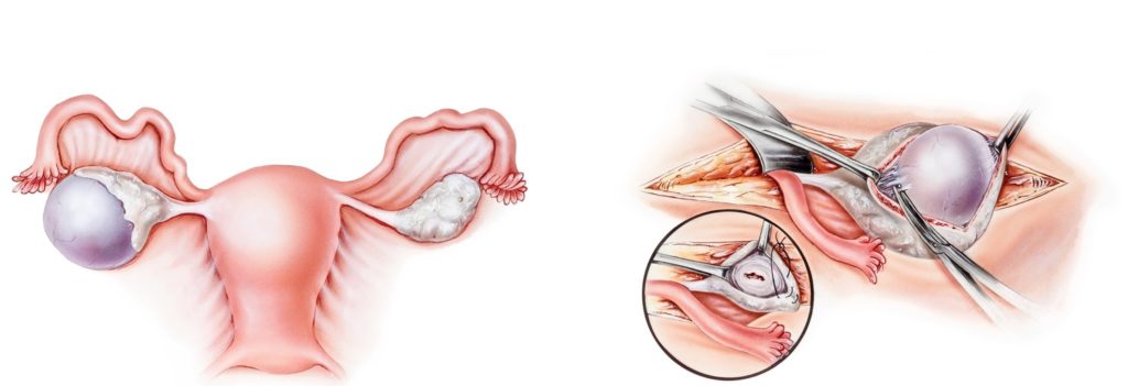 Yumurtalık Kisti Tedavisi