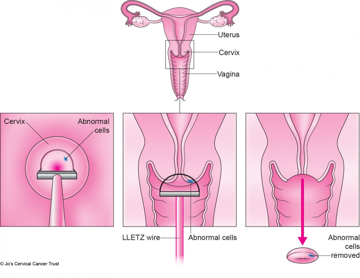 Rahim Ağzı Traşlama (Konizasyon)