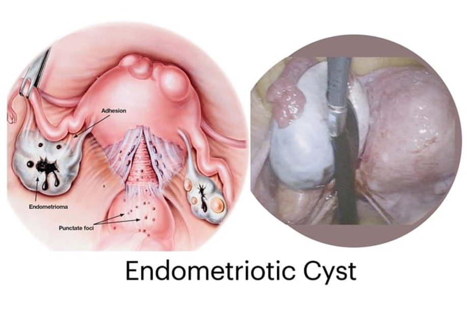 Endometriozis (Çikolata Kisti) Tedavisi